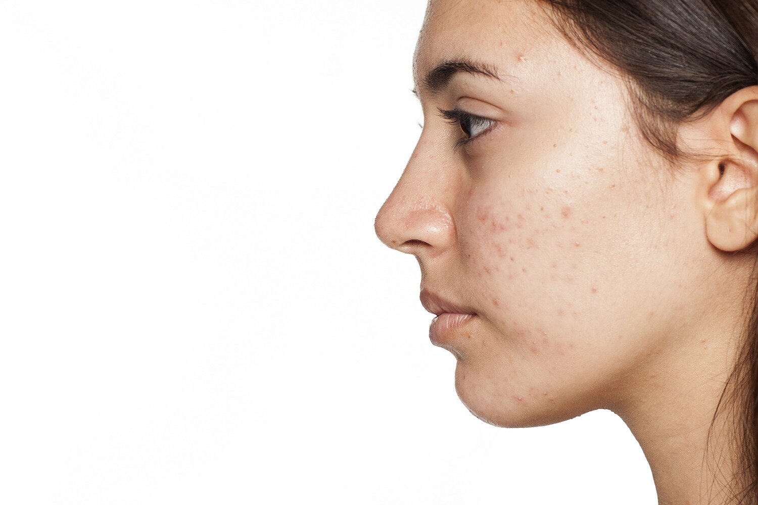 facial hyperpigmentation