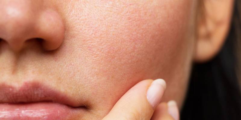 Dry Skin