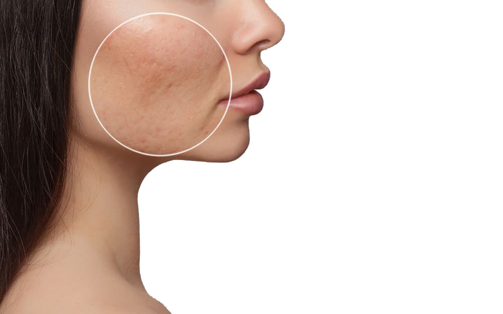 facial scarring